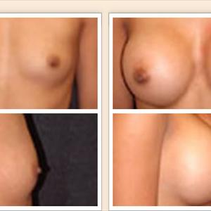 Breast Lift And Enlargement - How Do You Know Your Bra Fits You Perfectly?